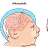 Microcefalie: cauze, simptome, complicatii