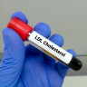 Colesterol LDL: ce este si care sunt valorile de referinta ale colesterolului “rau”