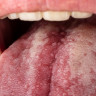 Glosodinie: cauze, simptome, diagnostic, tratament pentru ameliorarea durerii