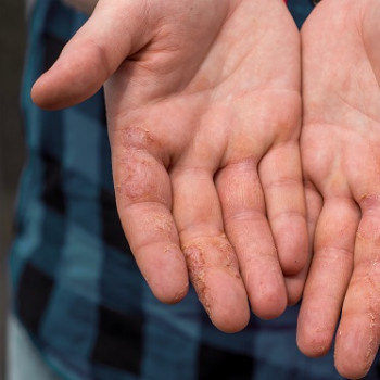 Ce declanseaza eczema dishidrotica si cum o puteti preveni in sezonul cald?