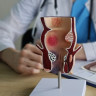  Regim alimentar de ajutor pentru persoanele care se confrunta cu hemoroizi