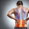 Sciatica – ce este, cauze, simptome si tratament