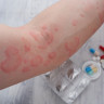Alergia la penicilina - cum sa identificati corect sensibilitatea la acest antibiotic