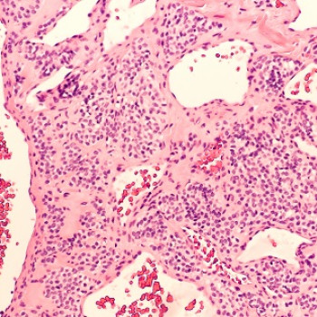 Tumora glomica: ce este, simptome, diagnostic si tratament