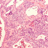 Tumora glomica: ce este, simptome, diagnostic si tratament