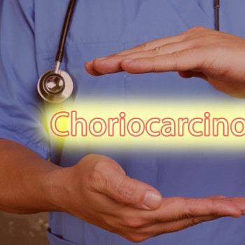 Coriocarcinom: ce este, cauze si cum se dezvolta aceasta forma rara de cancer