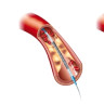 Stent la inima – informatii importante despre stentul coronarian