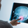 Glioblastom sau gliom cerebral de gradul IV - informatii complete