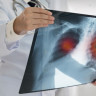 Edem pulmonar: cauze, simptome, diagnostic, tratament