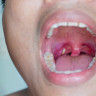 Pietre pe amigdale – simptome, cauze si preventie