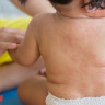 Roseola infantum sau boala a sasea a copilariei