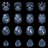 Tumora pineala: ce este, tipuri, simptome, diagnostic si tratament