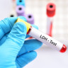 LDH in analizele de sange: Ce indica nivelul crescut sau scazut?