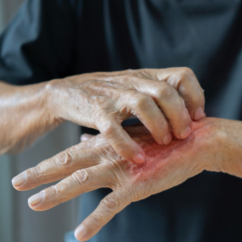 Sicozis stafilococic: cauze, simptome, tratament, complicatii