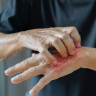 Sicozis stafilococic: cauze, simptome, tratament, complicatii
