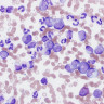 Neoplasm: tipuri, cauze, manifestari clinice, tratamente