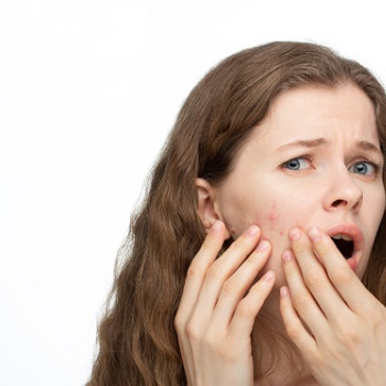Top 7 solutii naturale pentru acnee