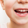 Durerea de dinti la copii - cauze si factori de risc
