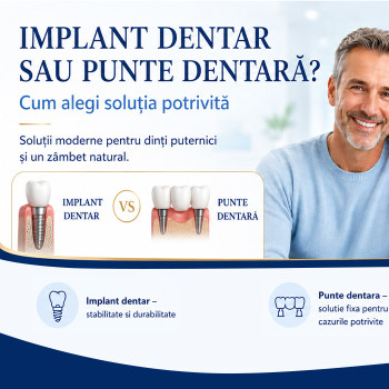 (P) Implant dentar sau punte dentara? Cum alegi solutia potrivita