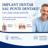 (P) Implant dentar sau punte dentara? Cum alegi solutia potrivita