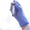 Ce este melioidoza? Simptome, cauze, diagnostic si tratament