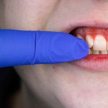 Sangerari gingivale: cauze, afectiuni asociate si tratament