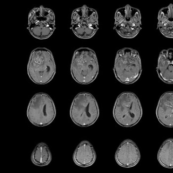 Craniofaringiom: ce este, cauze si cum afecteaza creierul