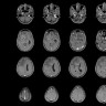 Craniofaringiom: ce este, cauze si cum afecteaza creierul