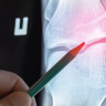 Osteom: ce este, cauze si factori de risc, tablou clinic, tratament