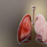 Hemotorax - simptome, diagnostic si tratament