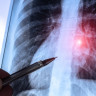 Adenopatiile intratoracice: ce sunt adenopatia mediastinala si adenopatia pulmonara (hilara)?