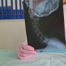 Mielodisplazie: cauze, factori de risc, simptome, diagnostic si tratament