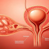 Ureterocel: tipuri, cauze, diagnostic, tratament si abordari chirurgicale