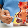 Cancer intestinal: ce este, tipuri si cum afecteaza sistemul digestiv