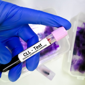Leucemie limfocitara cronica: cauze, simptome, diagnostic si tratament