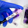 Leucemie limfocitara cronica: cauze, simptome, diagnostic si tratament