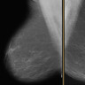 Carcinom ductal in situ (CDIS): clasificare, diagnostic imagistic si histopatologic, management