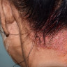 Pecingine: simptome, cauze, modalitati de tratament