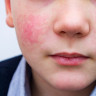 Boala obrajilor palmuiti: cauze, manifestari, diagnostic si tratament