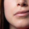 Pareza faciala – de ce apare, afectiuni asociate si tratament