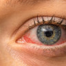 Ocluzia vasculara retiniana: tipuri, cauze, solutii de tratament