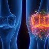 (P) Gonartroza sau artroza genunchiului