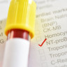 Test NT proBNP – ce este si care sunt explicatiile pentru valorile marite