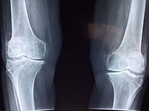 modificări degenerative în tratamentul articulației genunchiului)