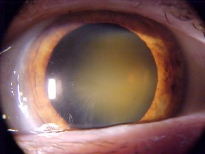 tratamentul vederii și cataractei