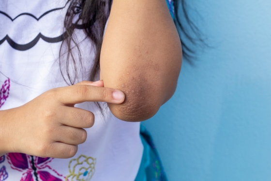 acanthosis-nigricans-cauze-simptome-tratament