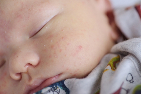 acneea-bebelusului-manifestari