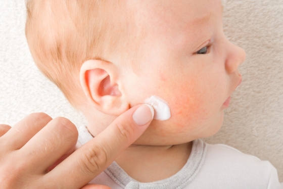 acneea-bebelusului-tratament