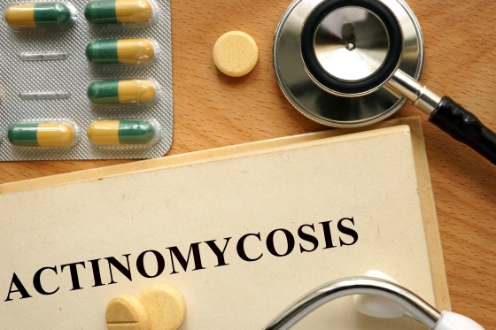 actinomicoza-cauze-factori-de-risc-simptome-tratament