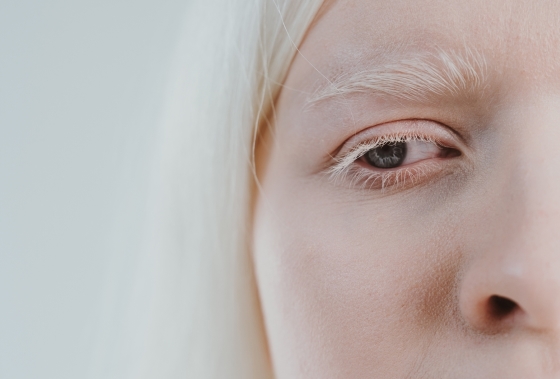 albinism-simptome-vedere